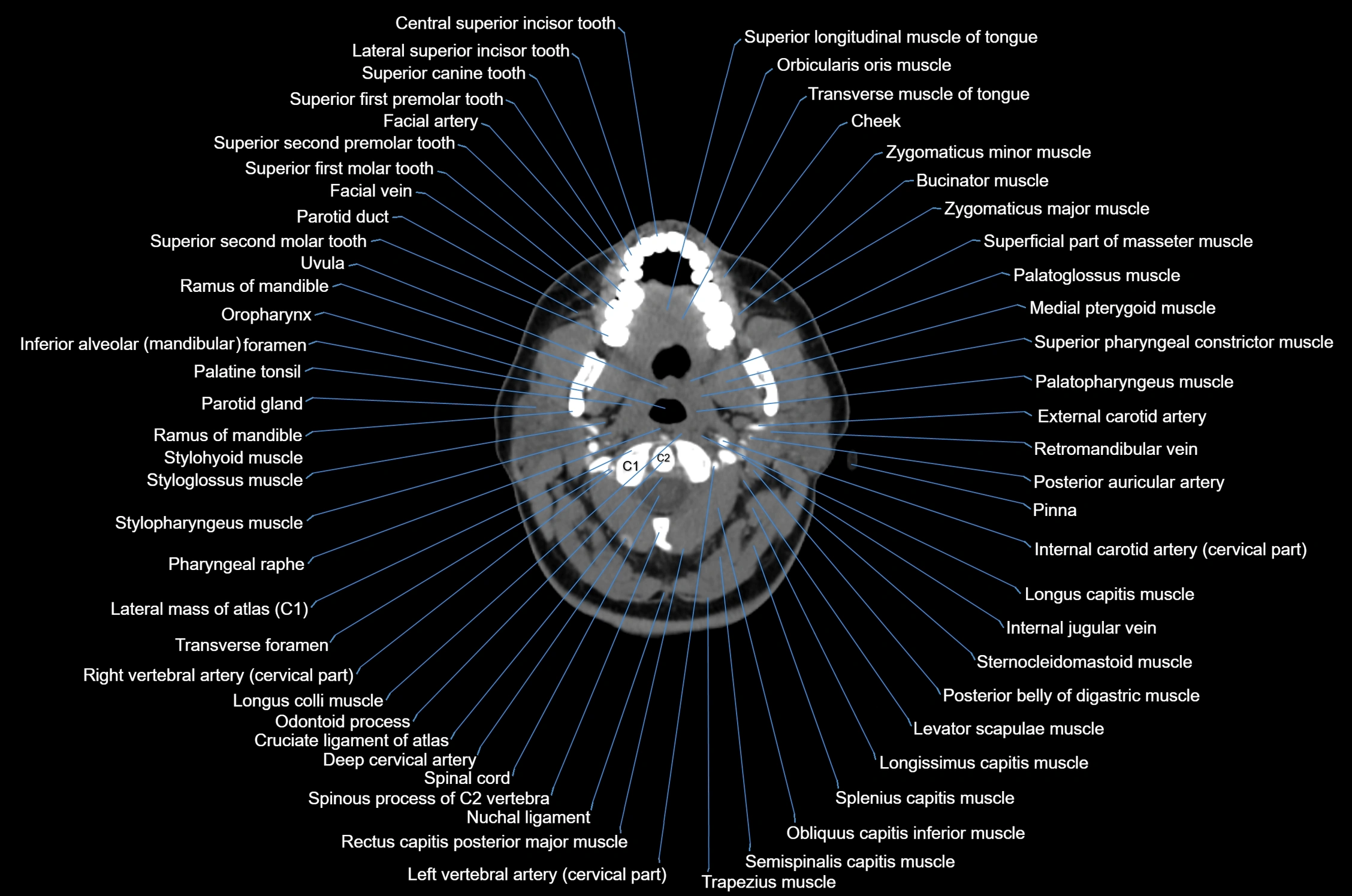 CT Neck axial cross sectional anatomy radiology image-img-00001-00025.webp